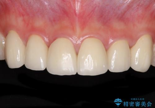 継ぎ接ぎだらけの前歯を綺麗にしたい 前歯のオールセラミックの治療後