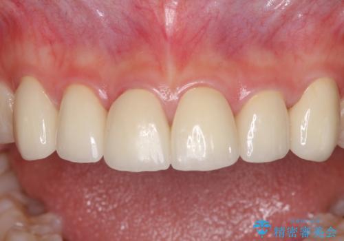 継ぎ接ぎだらけの前歯を綺麗にしたい 前歯のオールセラミックの治療後