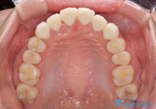 継ぎ接ぎだらけの前歯を綺麗にしたい 前歯のオールセラミックの治療後