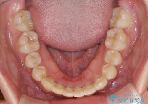 継ぎ接ぎだらけの前歯を綺麗にしたい　前歯のオールセラミックの治療後