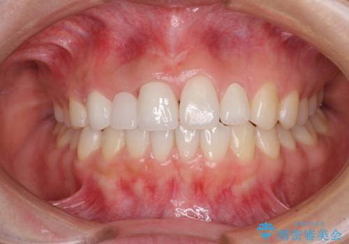 欠損歯と矮小歯　矯正治療と前歯のセラミック治療の症例 治療後