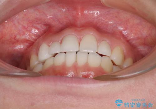 欠損歯と矮小歯 矯正治療と前歯のセラミック治療の治療後
