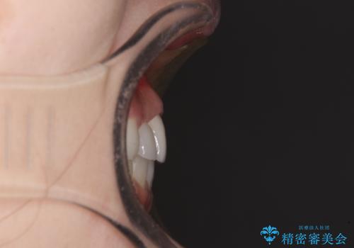 欠損歯と矮小歯 矯正治療と前歯のセラミック治療の治療後