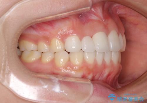 欠損歯と矮小歯 矯正治療と前歯のセラミック治療の治療後