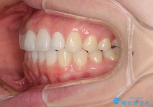 欠損歯と矮小歯 矯正治療と前歯のセラミック治療の治療後