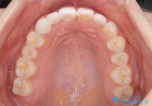 欠損歯と矮小歯 矯正治療と前歯のセラミック治療の治療後