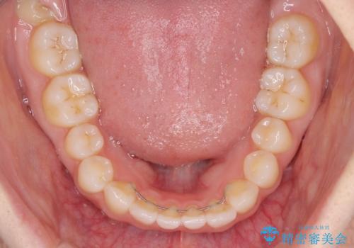 欠損歯と矮小歯 矯正治療と前歯のセラミック治療の治療後