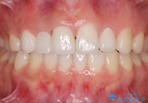 欠損歯と矮小歯　矯正治療と前歯のセラミック治療