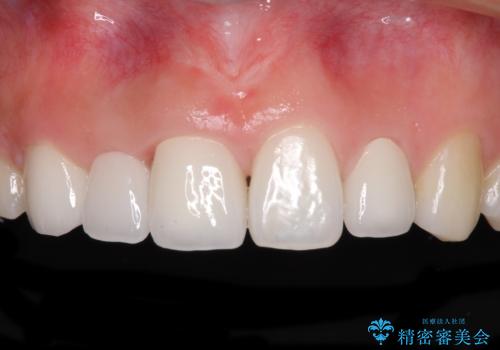 欠損歯と矮小歯 矯正治療と前歯のセラミック治療の治療後