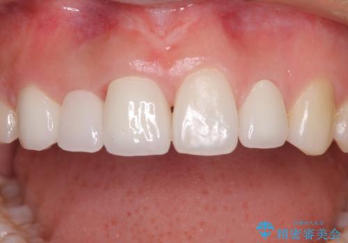 欠損歯と矮小歯　矯正治療と前歯のセラミック治療の治療後