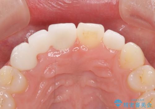 欠損歯と矮小歯 矯正治療と前歯のセラミック治療の治療後