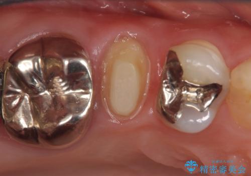 オールセラミッククラウン ズキズキ痛む歯の治療の治療中