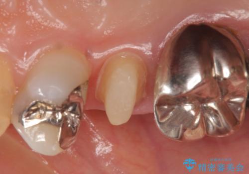 オールセラミッククラウン ズキズキ痛む歯の治療の治療中