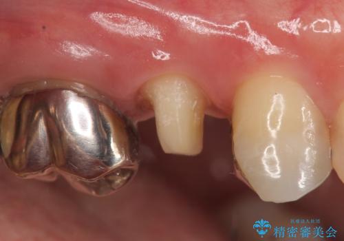 オールセラミッククラウン ズキズキ痛む歯の治療の治療中