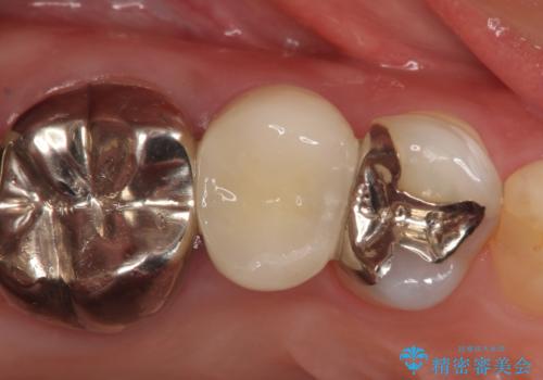 オールセラミッククラウン ズキズキ痛む歯の治療の治療後