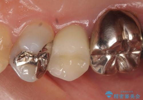 オールセラミッククラウン ズキズキ痛む歯の治療の治療後