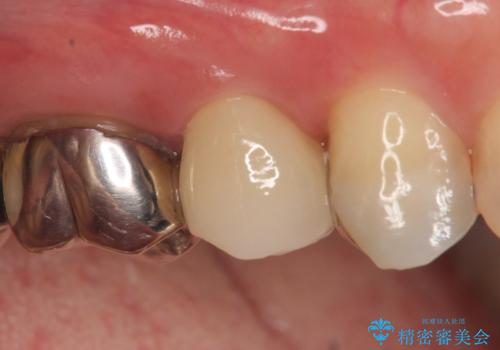 オールセラミッククラウン ズキズキ痛む歯の治療の症例 治療後