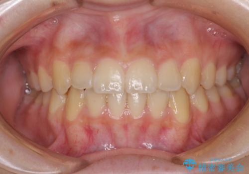 前歯のクロスバイト　メタル装置での矯正治療の症例 治療後