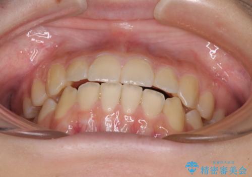 前歯のクロスバイト　メタル装置での矯正治療の治療後