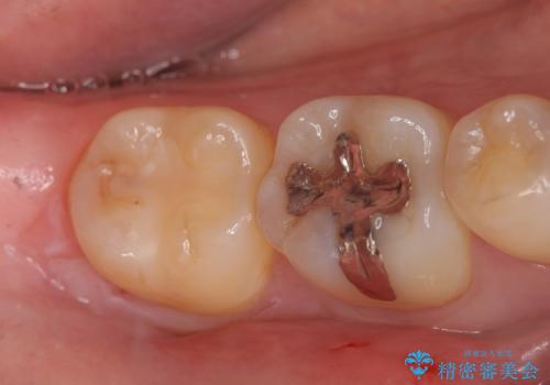 セラミックインレー 冷たいものがしみる奥歯の治療の症例 治療前