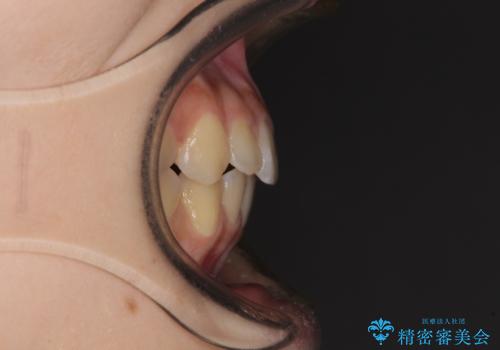 前歯のクロスバイト メタル装置での矯正治療の治療後