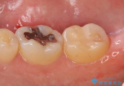 セラミックインレー 冷たいものがしみる奥歯の治療の治療前