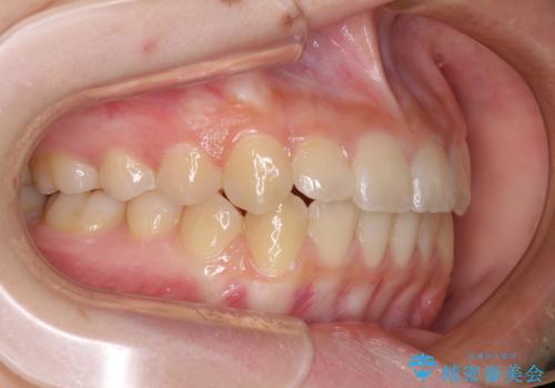 前歯のクロスバイト　メタル装置での矯正治療の治療後