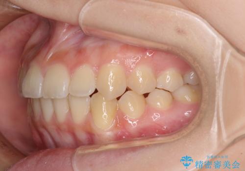 前歯のクロスバイト メタル装置での矯正治療の治療後