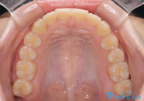 前歯のクロスバイト メタル装置での矯正治療の治療後