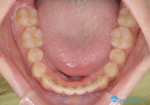 前歯のクロスバイト メタル装置での矯正治療の治療後