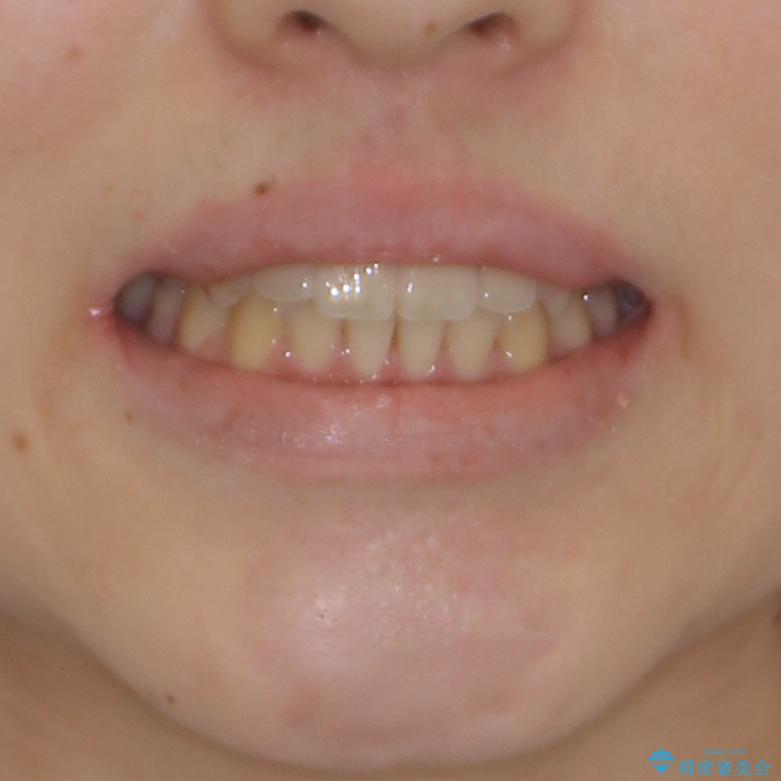 前歯のクロスバイト　メタル装置での矯正治療の治療後（顔貌）