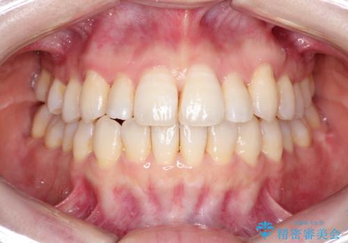 インビザラインで八重歯の矯正の治療後
