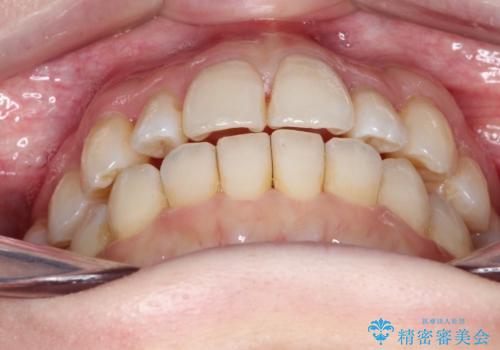 インビザラインで八重歯の矯正の治療後