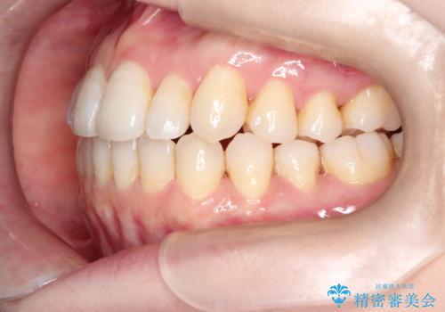 インビザラインで八重歯の矯正の治療後