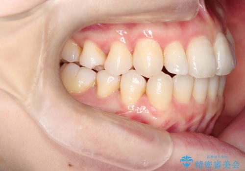 インビザラインで八重歯の矯正の治療後