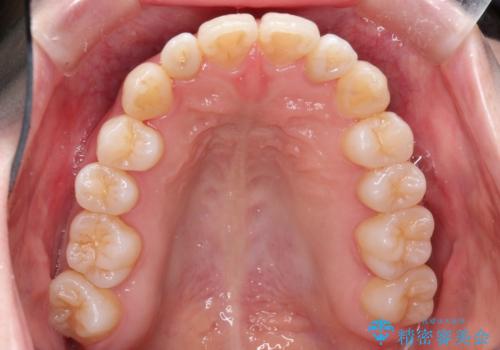 インビザラインで八重歯の矯正の治療後