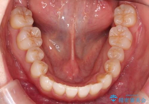 インビザラインで八重歯の矯正の治療後