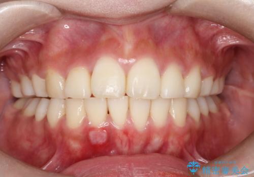 前歯で咬めない・出っ歯　抜歯矯正で整った上下の前歯への症例 治療後