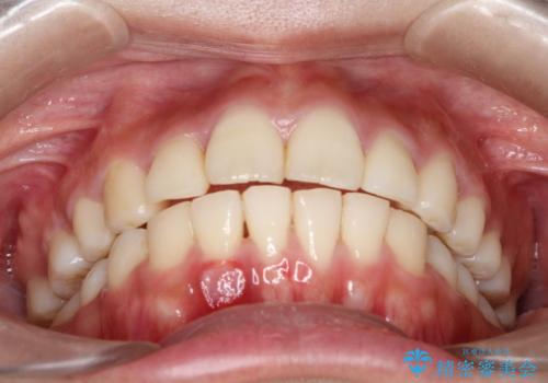 前歯で咬めない・出っ歯　抜歯矯正で整った上下の前歯への治療後