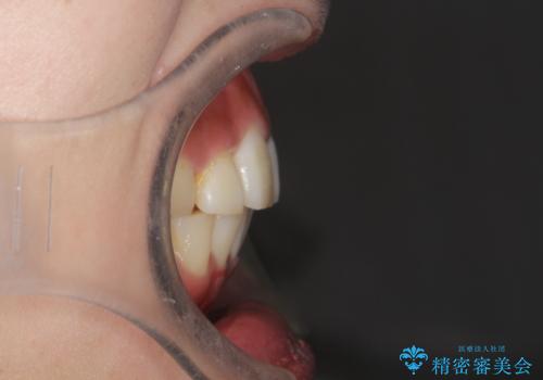 前歯で咬めない・出っ歯 抜歯矯正で整った上下の前歯への治療後