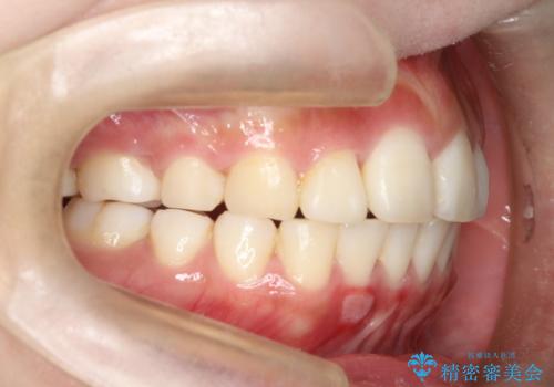 前歯で咬めない・出っ歯 抜歯矯正で整った上下の前歯への治療後