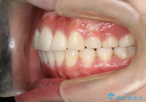 前歯で咬めない・出っ歯　抜歯矯正で整った上下の前歯への治療後