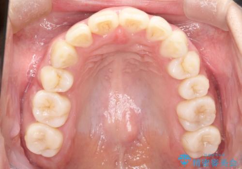 前歯で咬めない・出っ歯 抜歯矯正で整った上下の前歯への治療後