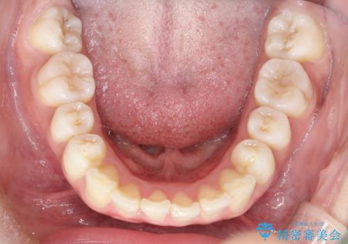 前歯で咬めない・出っ歯 抜歯矯正で整った上下の前歯への治療後
