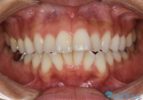 歯科衛生士によるPMTCで着色落としの治療前