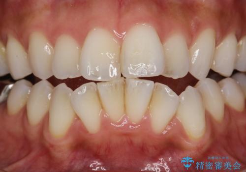 PMTCで歯石やステインの除去の治療前