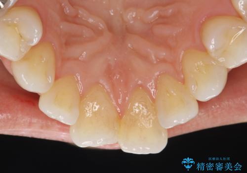 PMTCで歯石やステインの除去の治療前