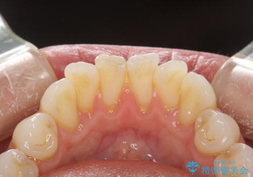 PMTCで歯石やステインの除去の治療前