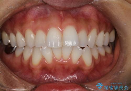 PMTCで歯石やステインの除去の治療後
