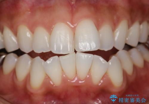 PMTCで歯石やステインの除去の治療後